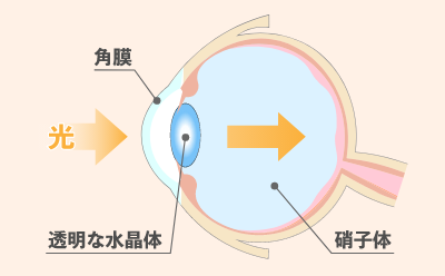 硝子体手術