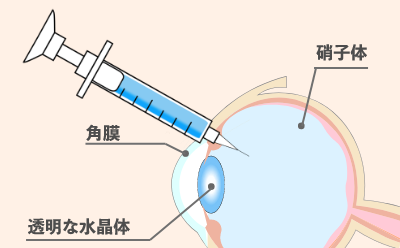 硝子体注射