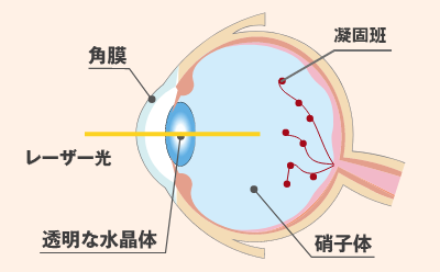 網膜光凝固術