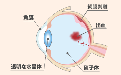 糖尿病網膜症